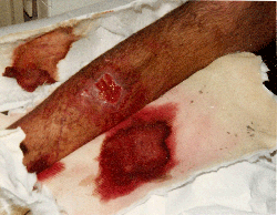 Billy O's leg months after the accident